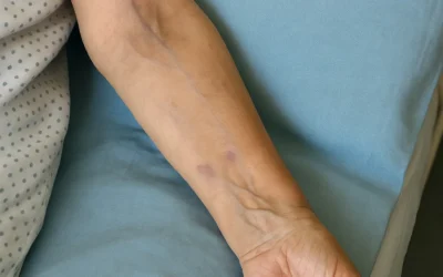 Infección de línea media en paciente con prótesis de cadera